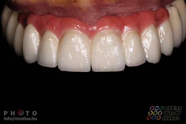 Intraocclusal screw retained upper long span bridge of PBC with gingiva made of ceramic.-4