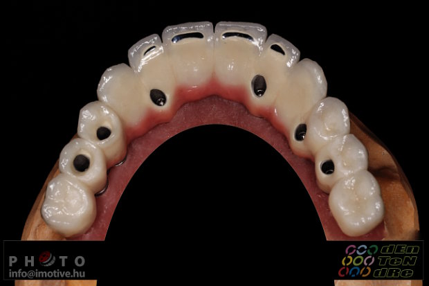 Intraocclusal screw retained upper long span bridge of PBC with gingiva made of ceramic.-5