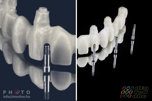 Upper screw retained long span bridge frame made of zirconium.