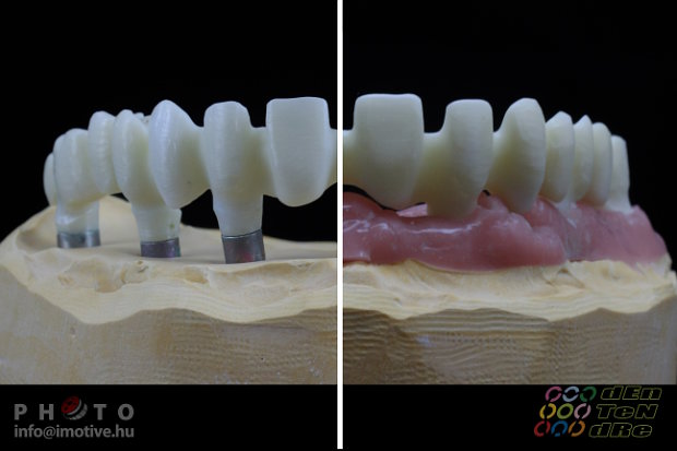Upper screw retained long span bridge frame made of zirconium.-3