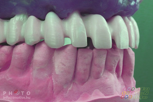 Upper screw retained long span bridge frame made of zirconium.-5